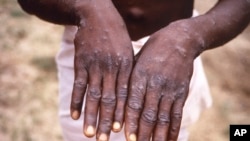 Mpox u Kongu