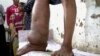 FILE - A leg disfigured by elephantiasis, Egypt, Oct. 3, 2004.