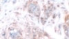 Invasive breast cancer tissue