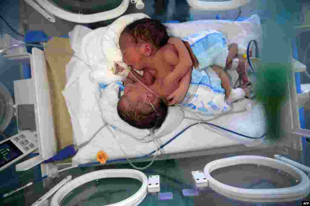 Newborn conjoined twins lie in an incubator at the child intensive care unit of al-Sabeen hospital in Yemen&#39;s capital Sanaa. The boys, born in war-ravaged Yemen, are in critical condition and in need of treatment abroad, according to the hospital.
